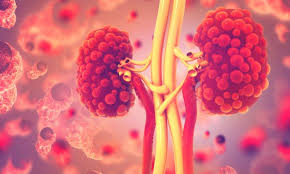 polycystic kidney