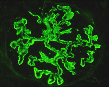 glomerulonephropathy cell image