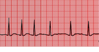 atrial fibrillation chart