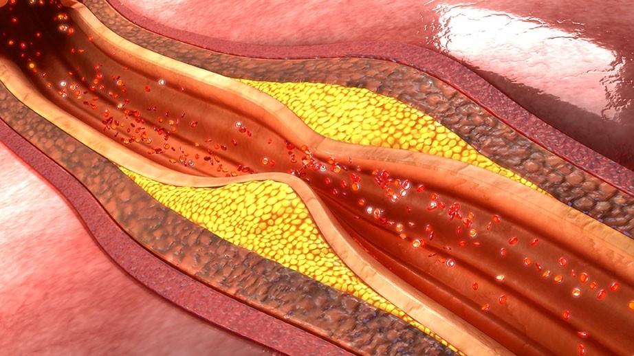 atherosclerosis graphic