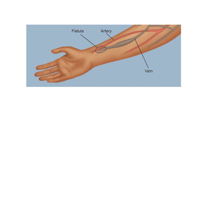 Fistula