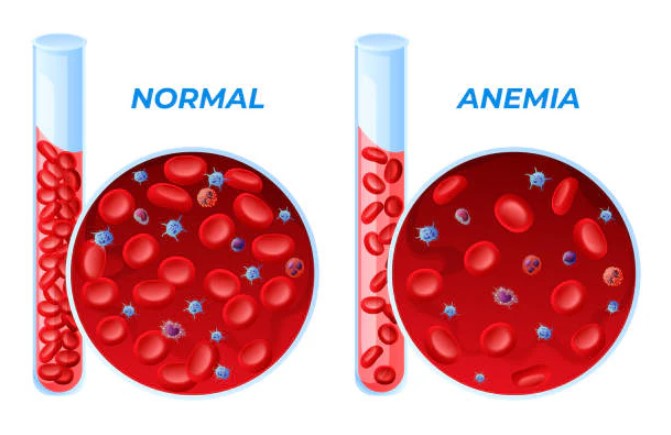 anemia cell image