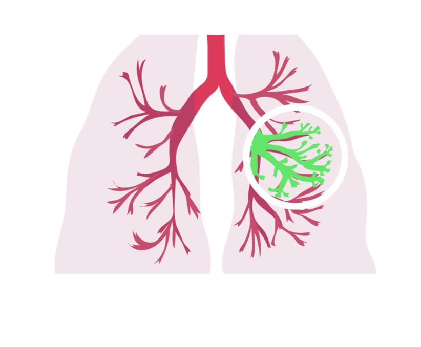 cystic fibrosis