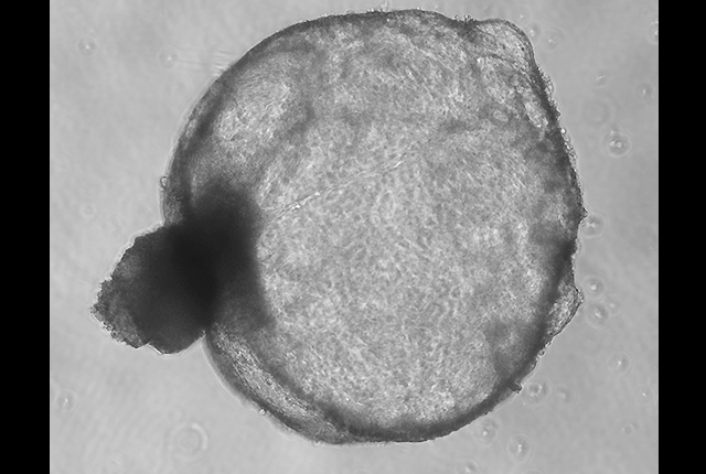 Cyst PKD