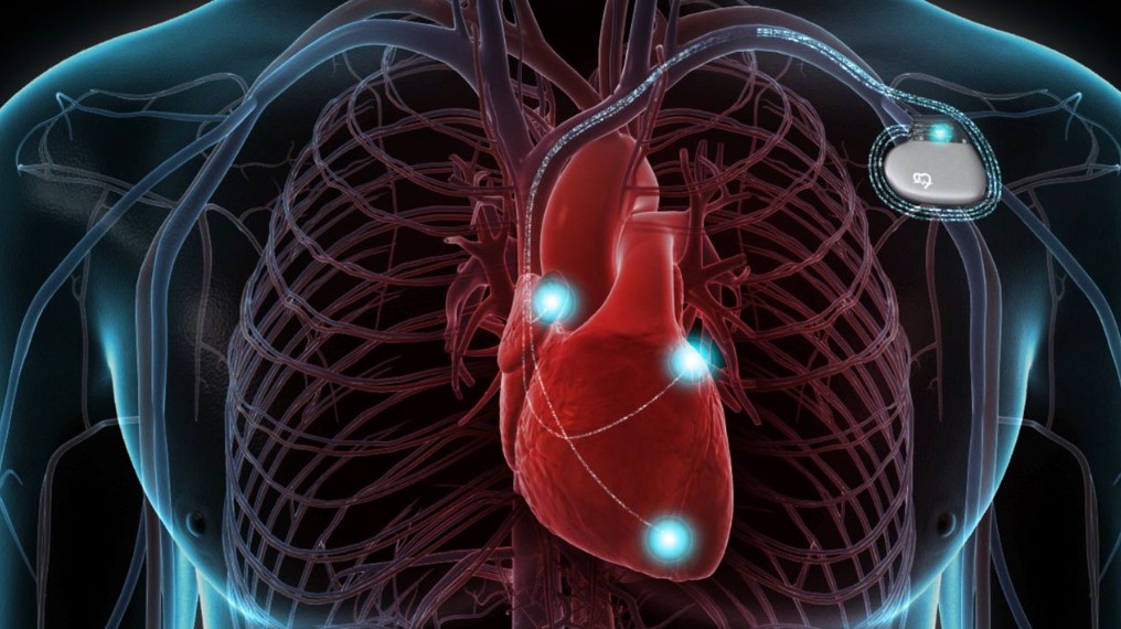 cardioverter defib