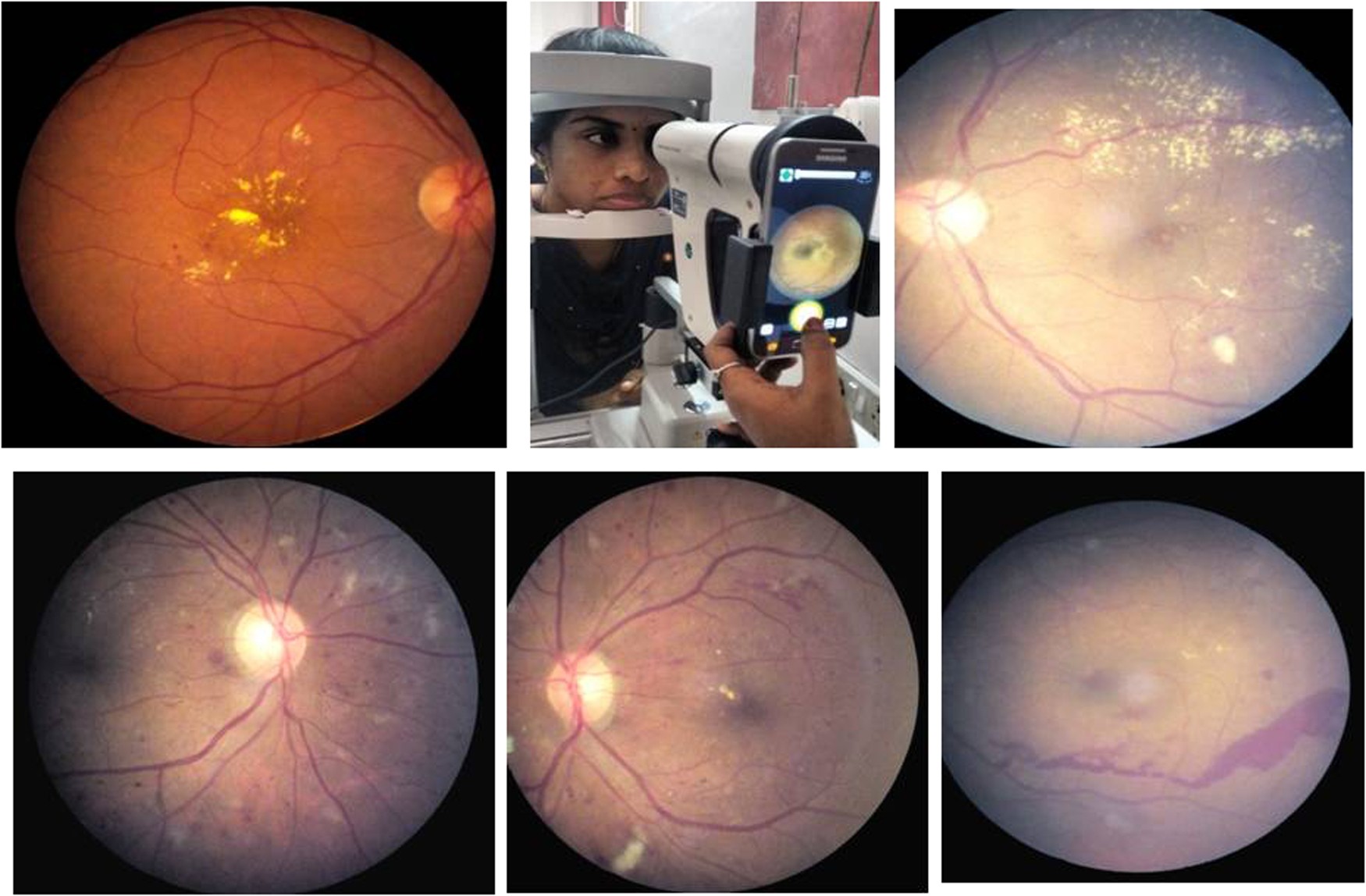 diabetic retinopathy images