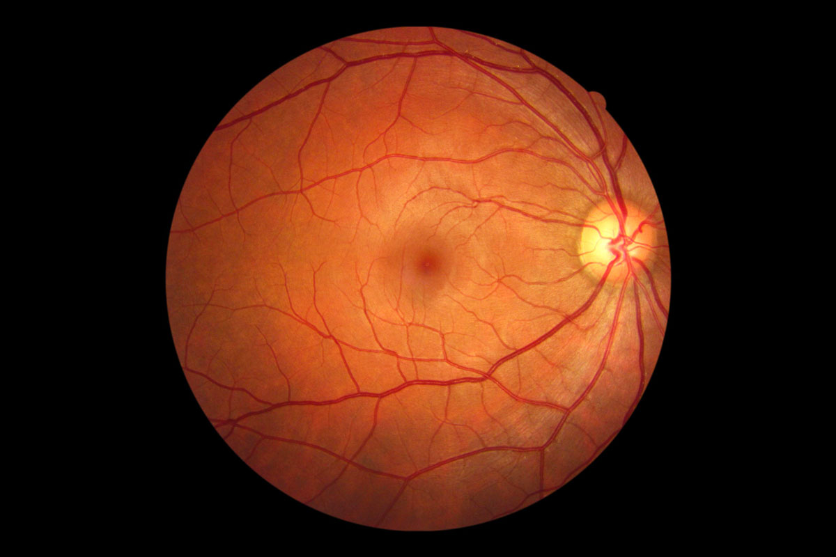 retinal image 